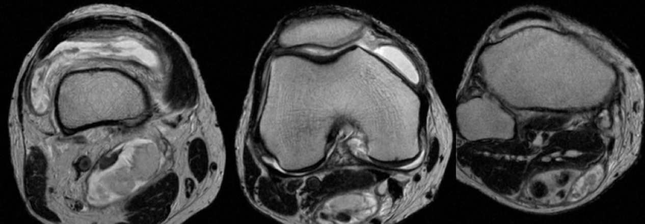 Figure 2 for case Complex baker cyst ( RID3892 )